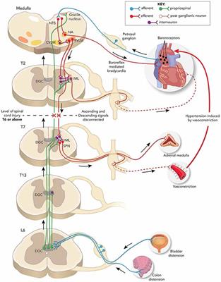 Intraspinal Plasticity Associated With the Development of Autonomic Dysreflexia After Complete Spinal Cord Injury